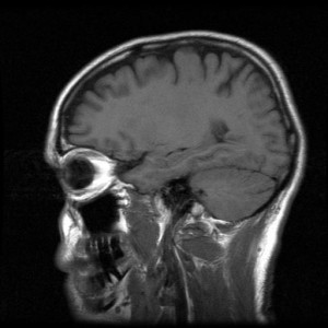 MRI scans show changes in the brain